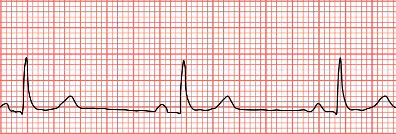 File:Sinus bradycardia lead2.svg